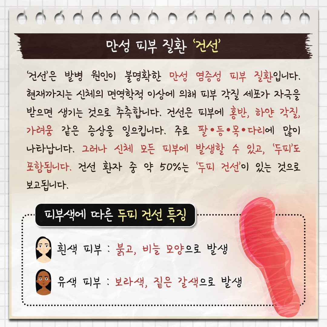두피 건선__02.jpg