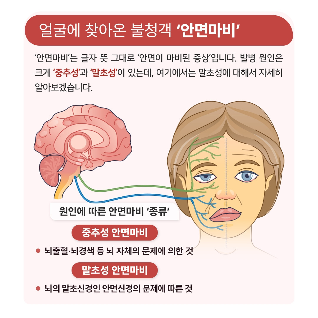 안면마비_02.jpg