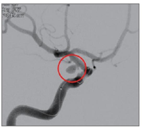 5_뇌동맥류, 뇌지주막하출혈 사진1.jpg