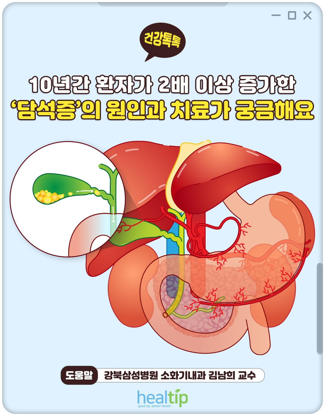 담석증_01_힐팁.jpg