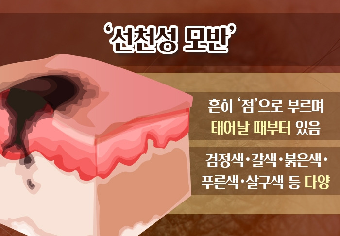 선천성 모반_02 .jpg