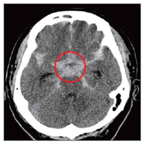 5_뇌동맥류, 뇌지주막하출혈 사진2.jpg
