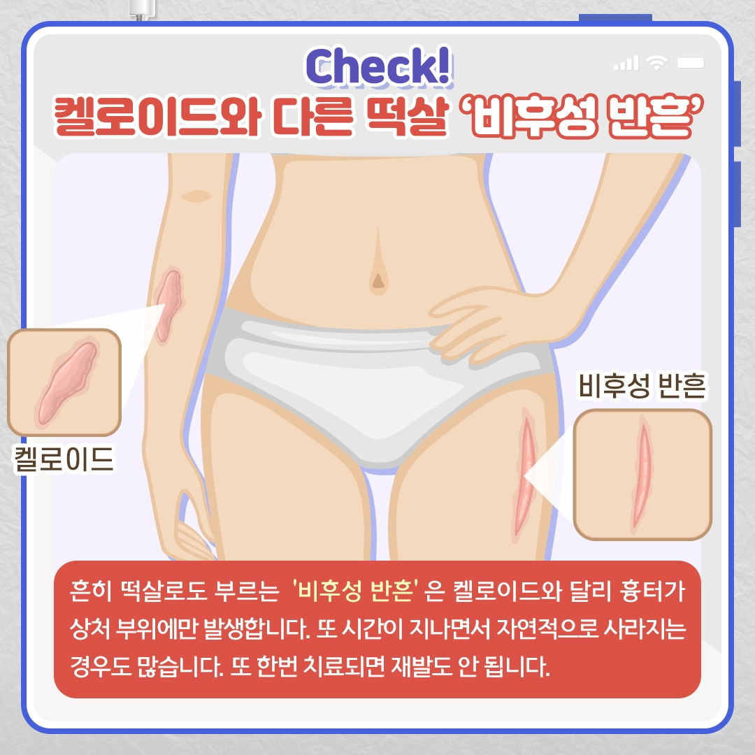 켈로이드_05 .jpg