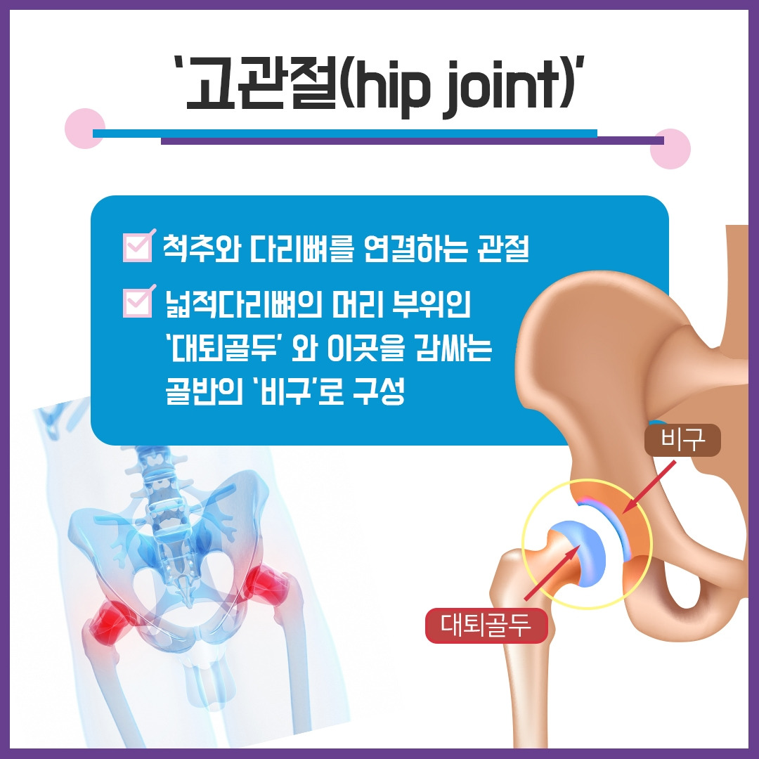 고관절 골절3.jpg