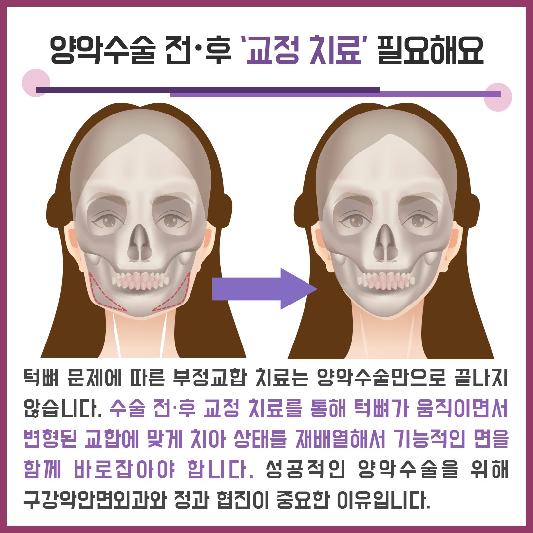 양악수술_03 .jpg