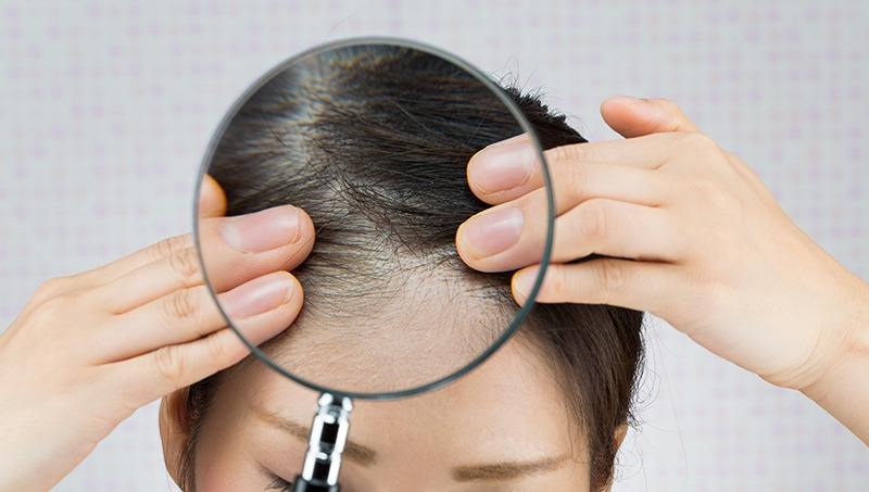 5.▶탈모 환자 중 44%가 여성.jpg