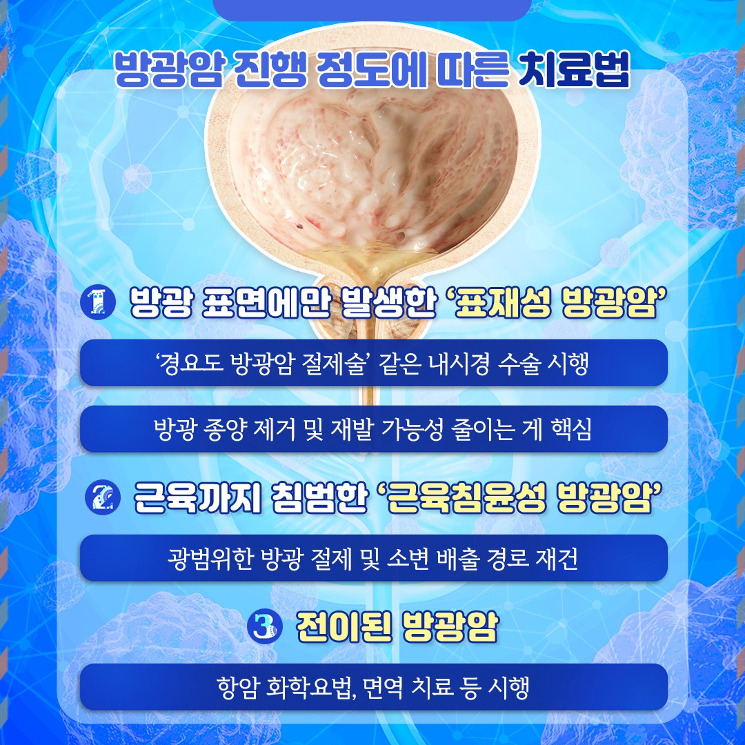 방광암_05.jpg