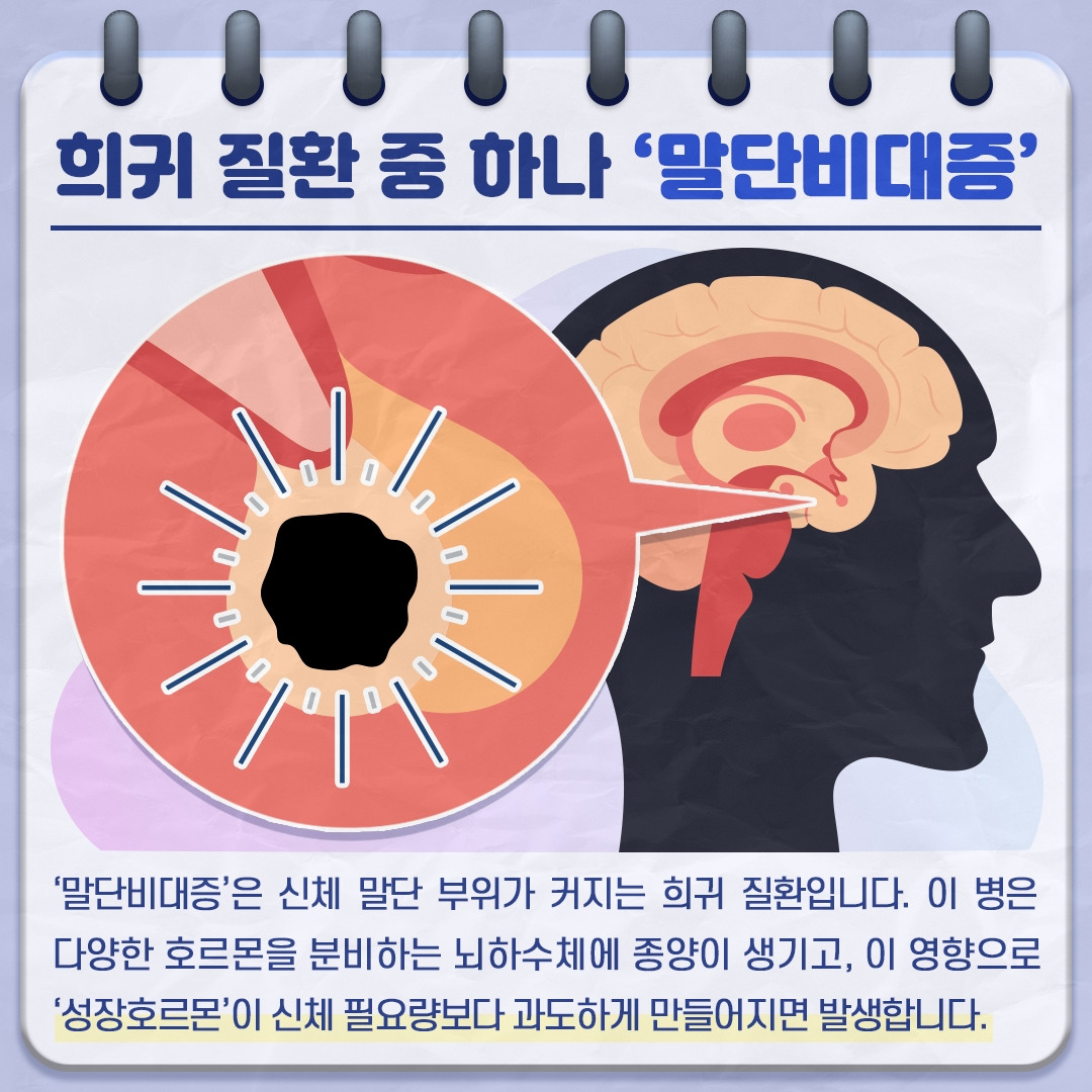 말단비대증_02 .jpg