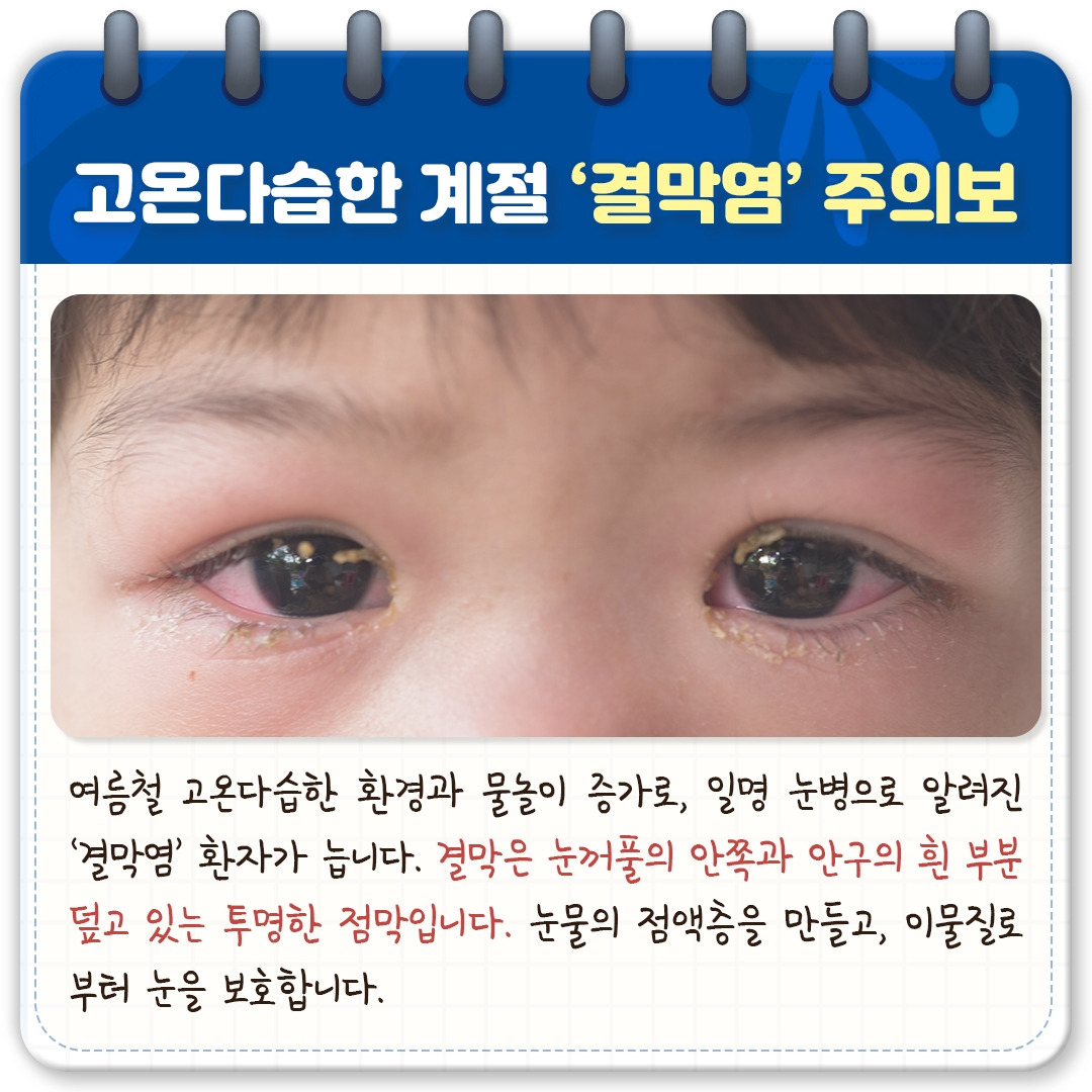 결막염_02.jpg