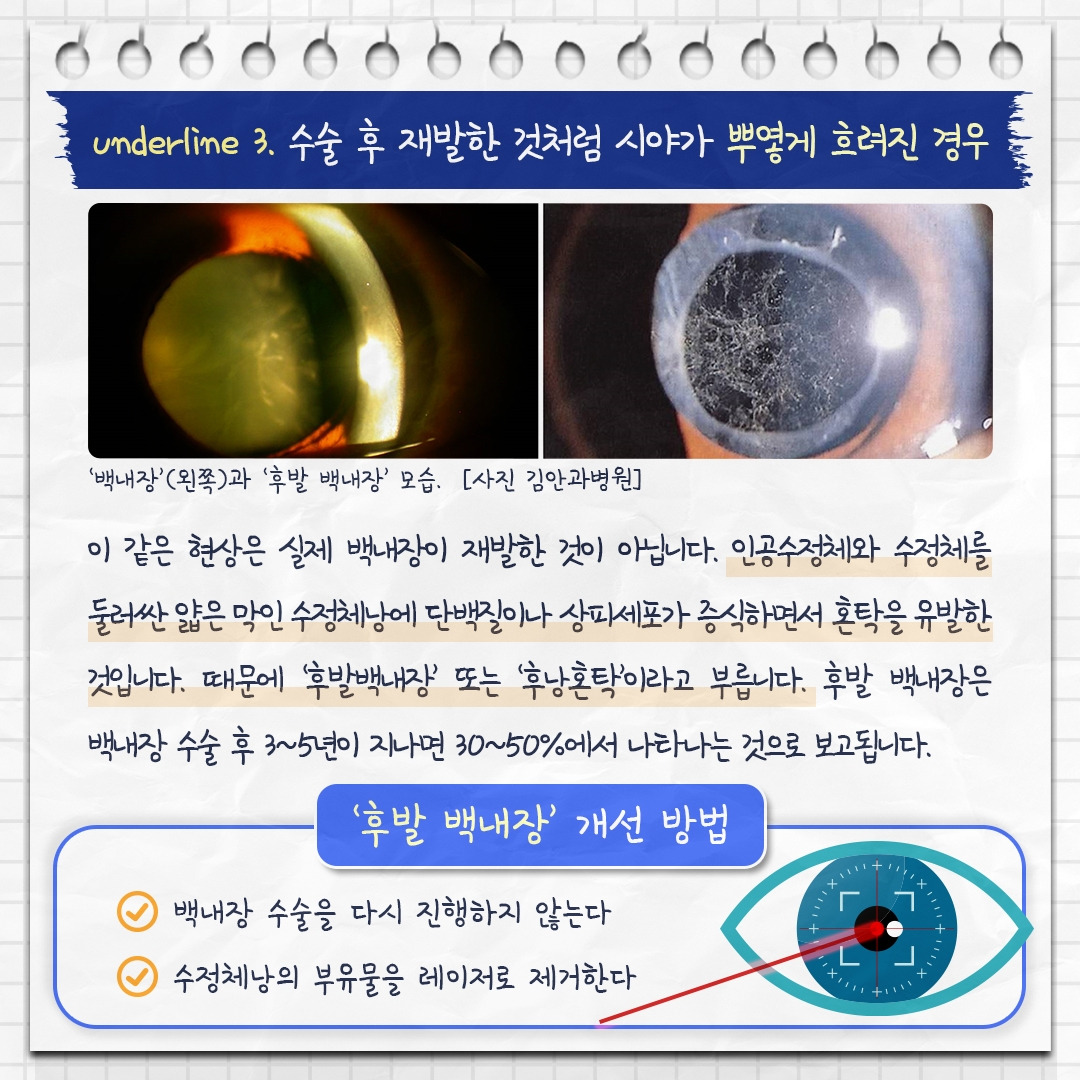 백내장 재수술_08 .jpg