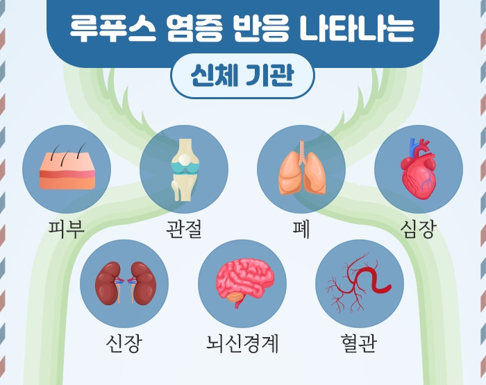 전신 홍반성 루푸스_6 .jpg