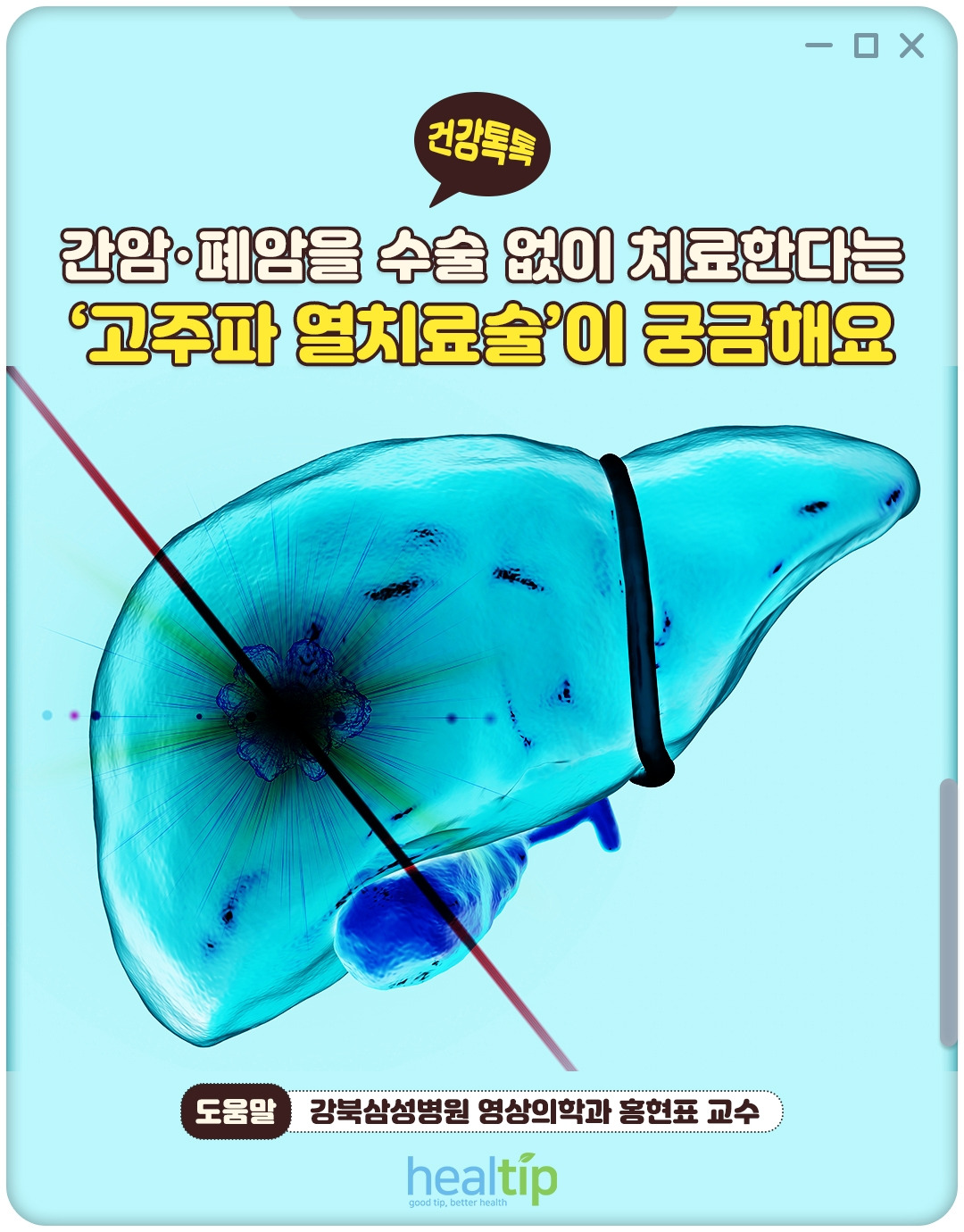 고주파열치료_01_힐팁.jpg