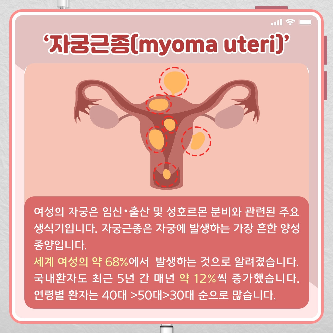 자궁근종_02 .jpg