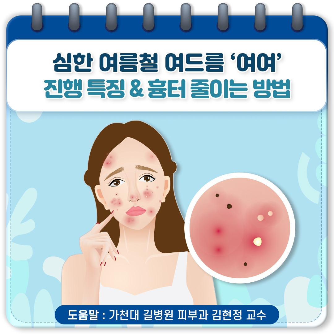 여름철 여드름_01.jpg