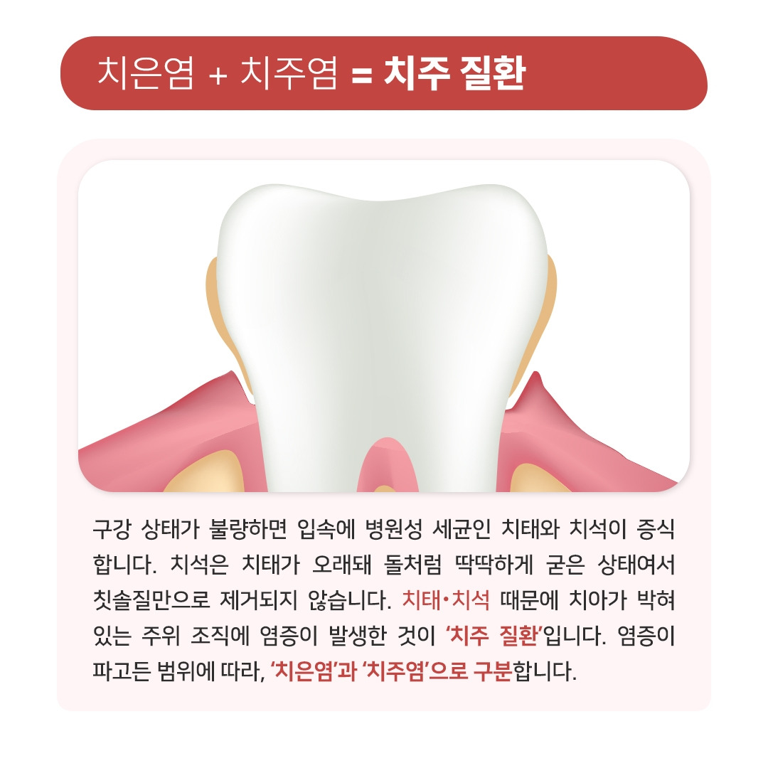 치은염&치주염_02.jpg
