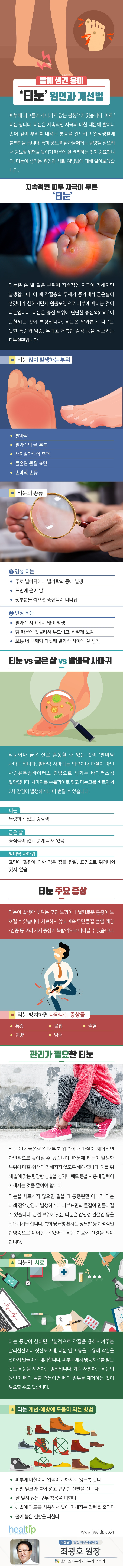 발에 생긴 옹이 ‘티눈’ 원인과 개선법_190929.jpg