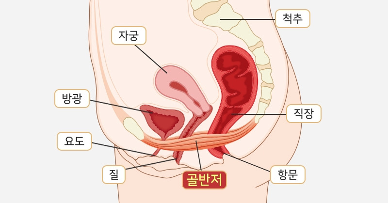 2.▶골반지지 근육 느슨해지면 발생.jpg