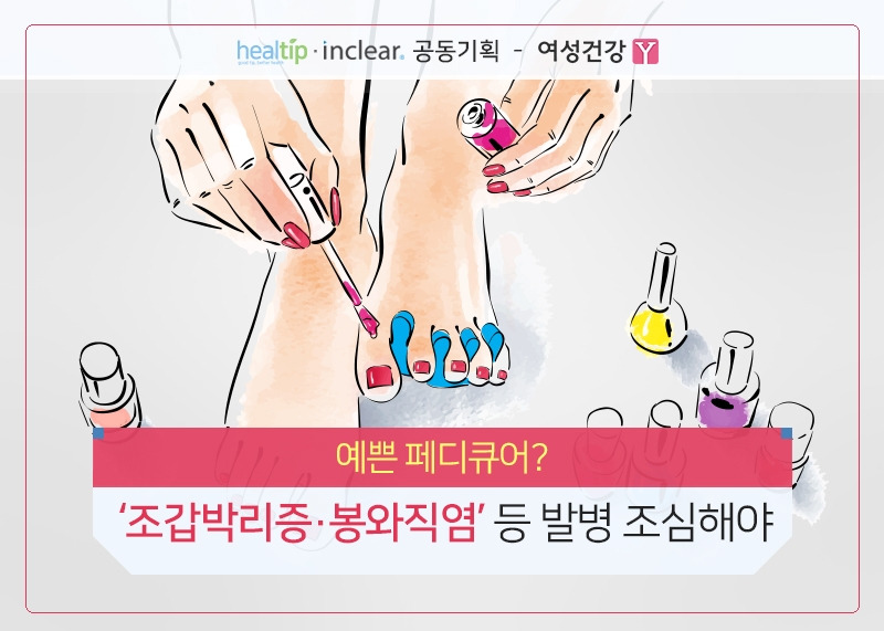 1.예쁜 페디큐어 ‘조갑박리증’ 등 발병 조심해야.jpg