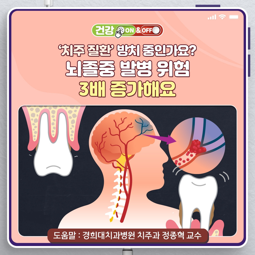 치주질환뇌졸중_01.jpg