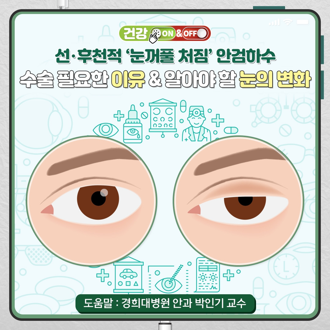 안검하수_01.jpg