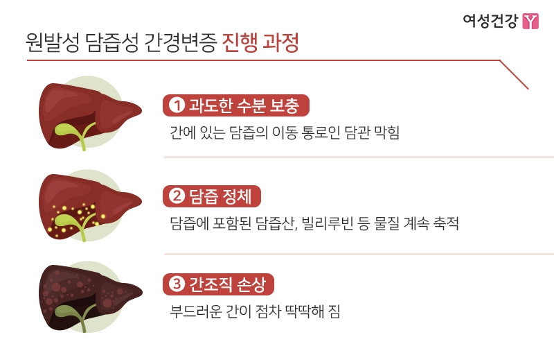 3.※원발성 담즙성 간경변증 진행 과정.jpg
