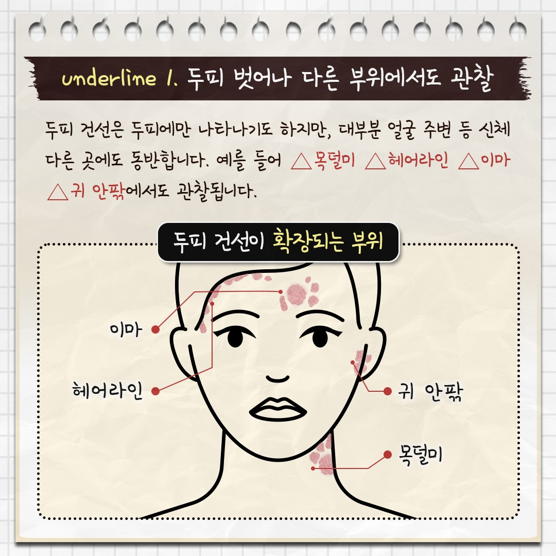 두피 건선__03.jpg