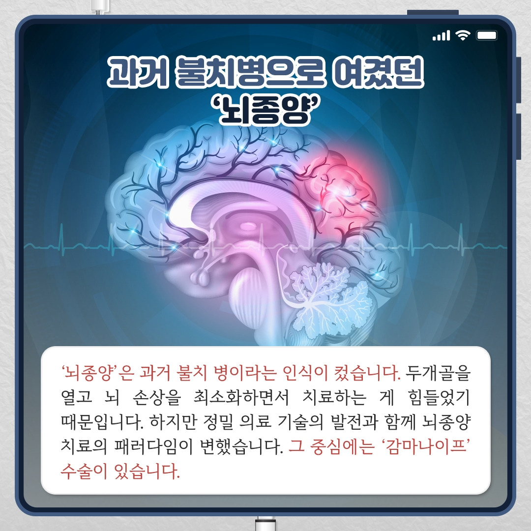 뇌종양 감마나이프수술_02.jpg