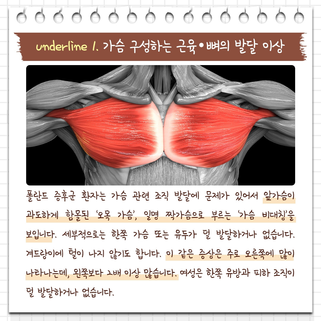 폴란드증후군_04 .jpg