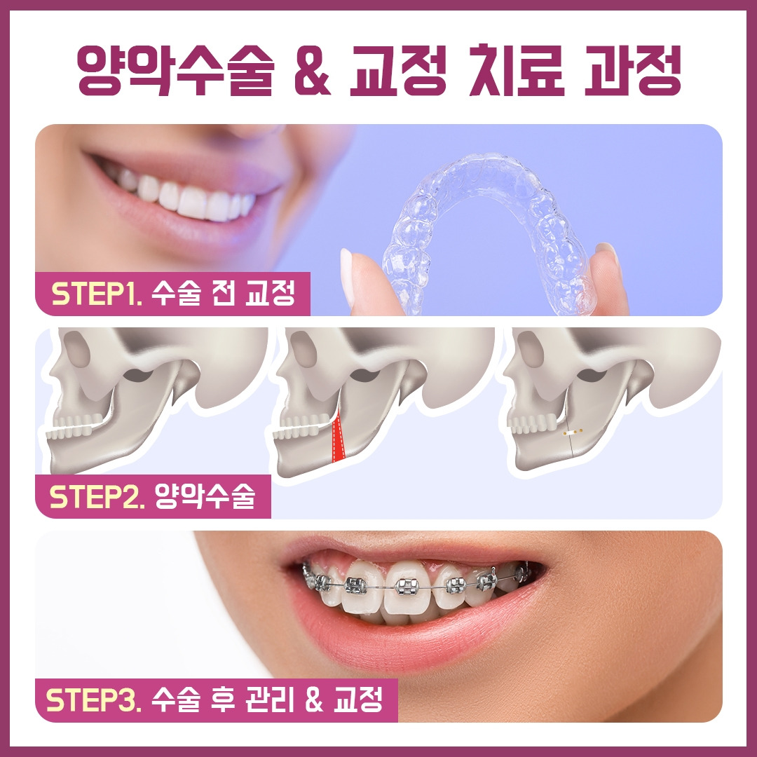 양악수술_04.jpg