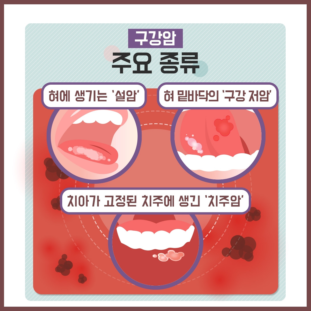 구강암_03.jpg