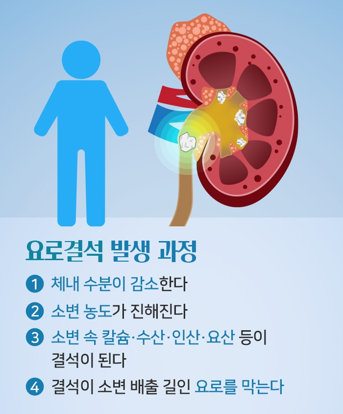요로결석_3.jpg