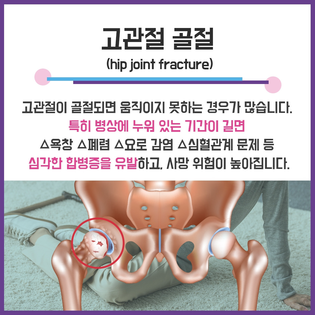 고관절 골절2.jpg