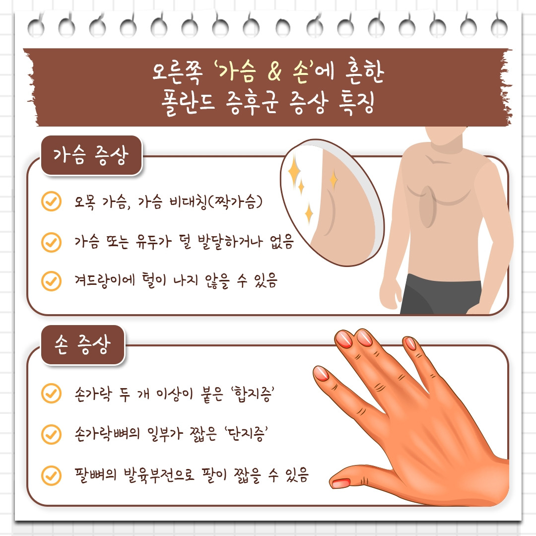 폴란드증후군_03 .jpg