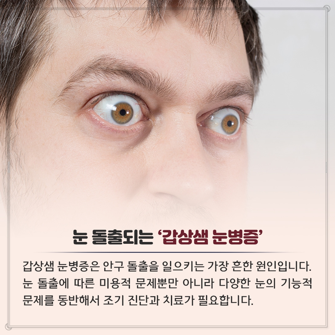 갑상샘 눈병증_02.jpg
