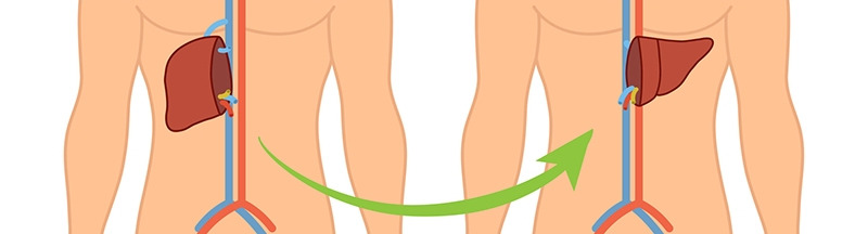 6.▶발견 늦으면 간 딱딱해져서 간이식 필요.jpg