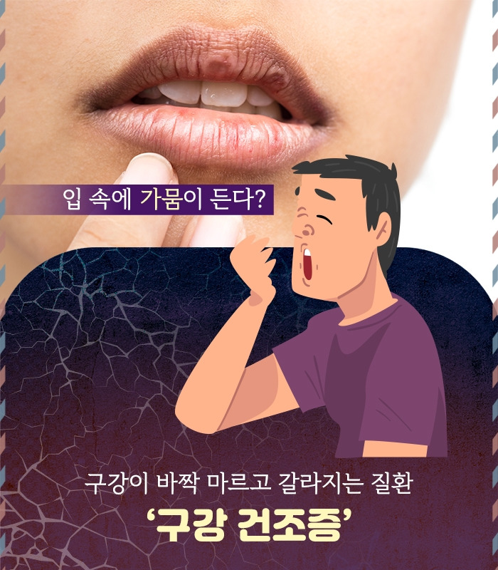 구강건조증_02.jpg