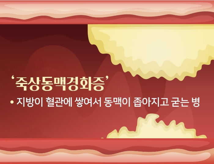죽상동맥경화증_1.jpg