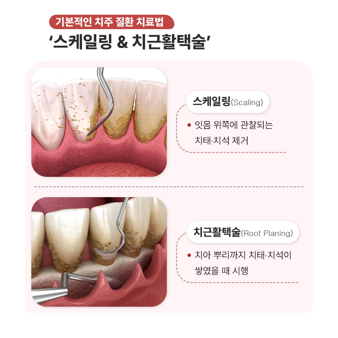 치은염&치주염_04.jpg