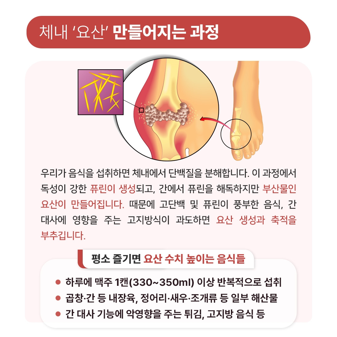 통풍발작_06.jpg