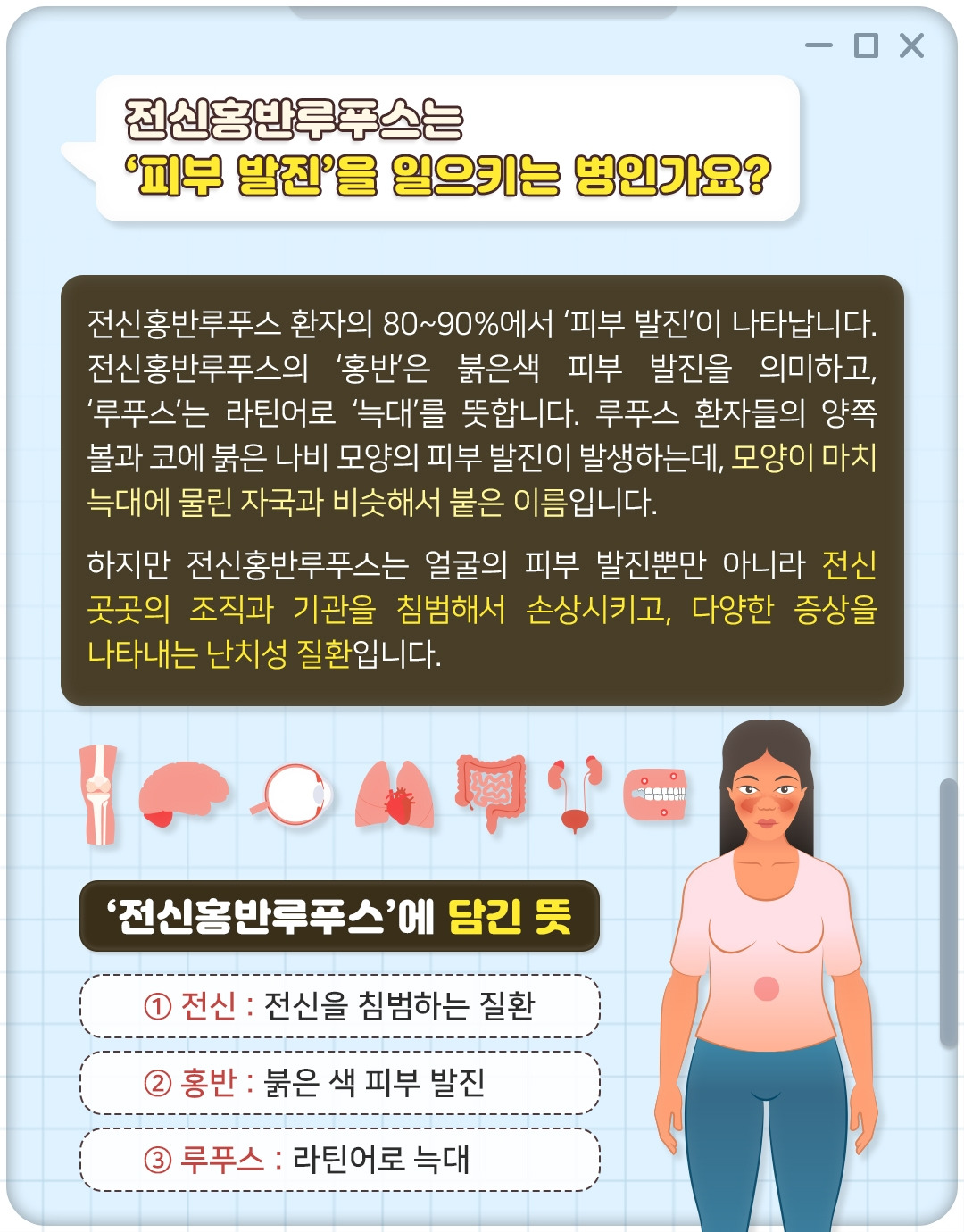 전신홍반루프스_05.jpg