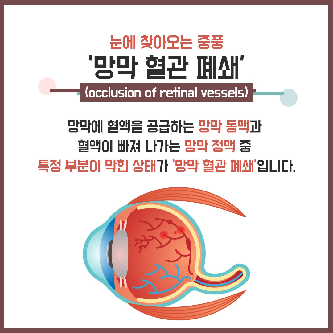 망막혈관폐쇄_02.jpg