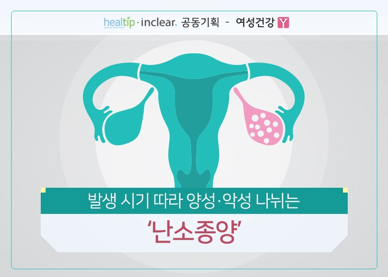 1.발생 시기 따라 양성‧악성 나뉘는 ‘난소종양’.jpg