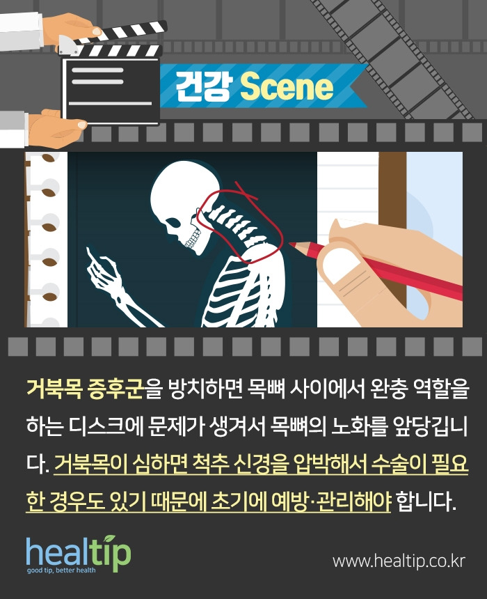 거북목 증후군_8.jpg