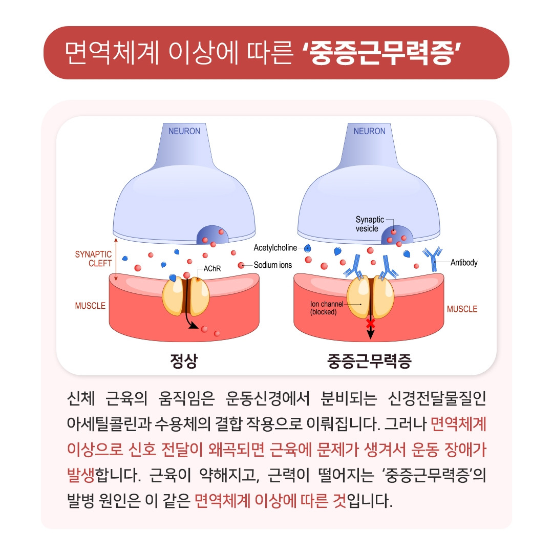 중증근무력증_03.jpg