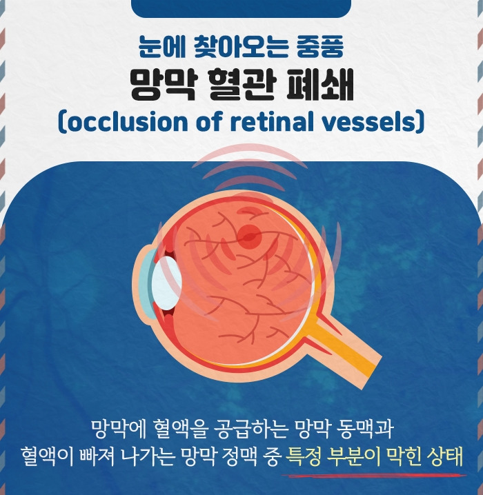망막 혈관 폐쇄_2 .jpg