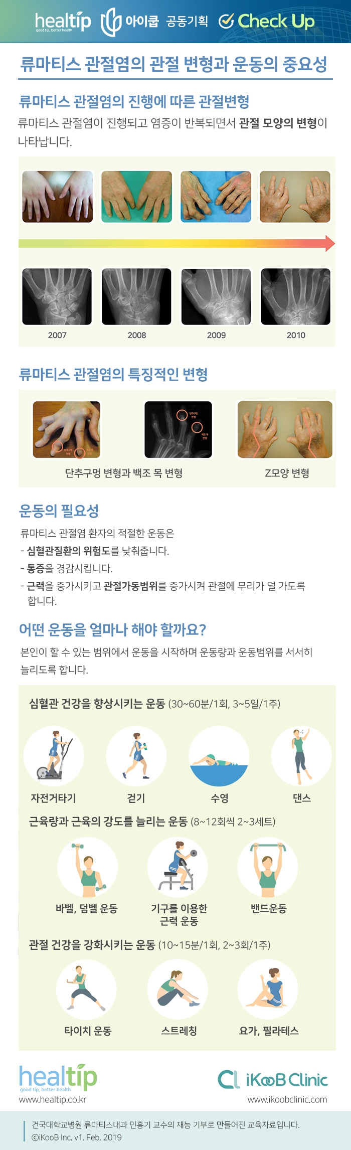 체크업 20_류마티스 관절염의 관절 변형과 운동의 중요성.jpg
