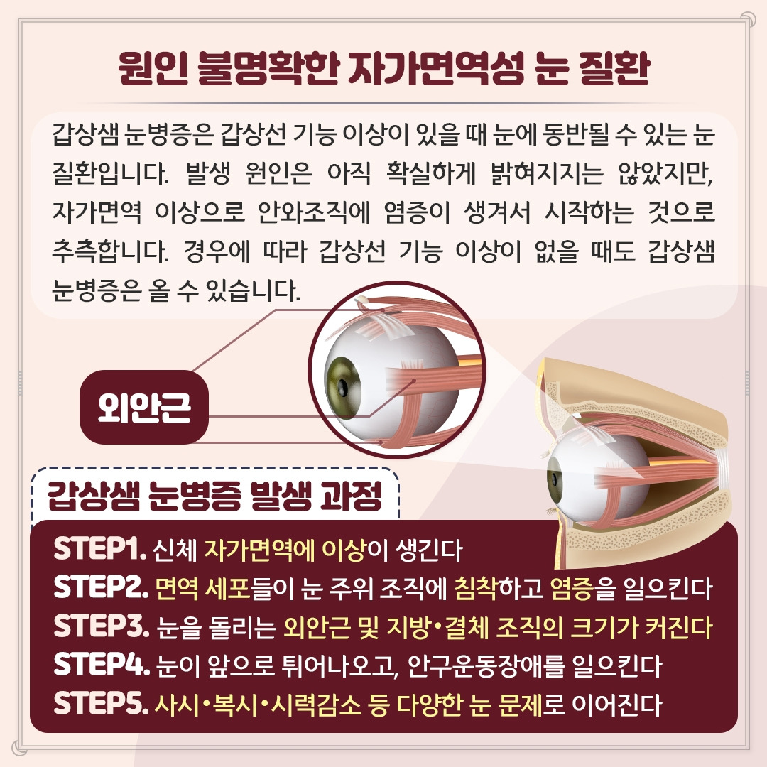 갑상샘 눈병증_03.jpg