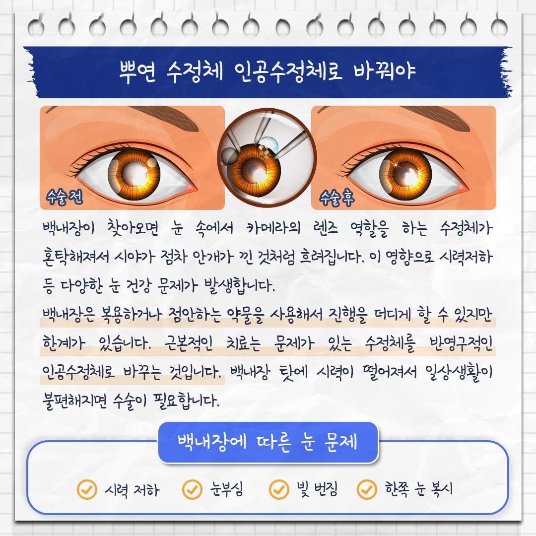 백내장 재수술_03 .jpg