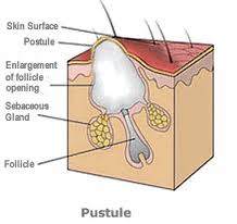 pustule.jpg