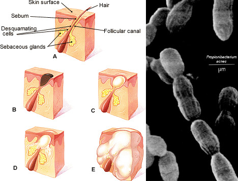 propionibacterium-acnes.jpg